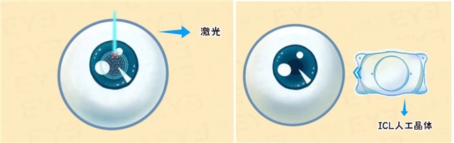 做完近视手术爱尔英智眼科医院王文娟主任提醒您还需注意这3点(图1)